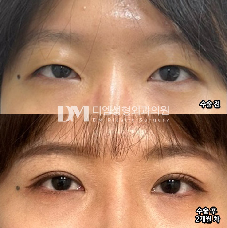 눈성형 후기."이쁘게 자리 잘 잡아서 만족스러워요!" 관련 이미지 2