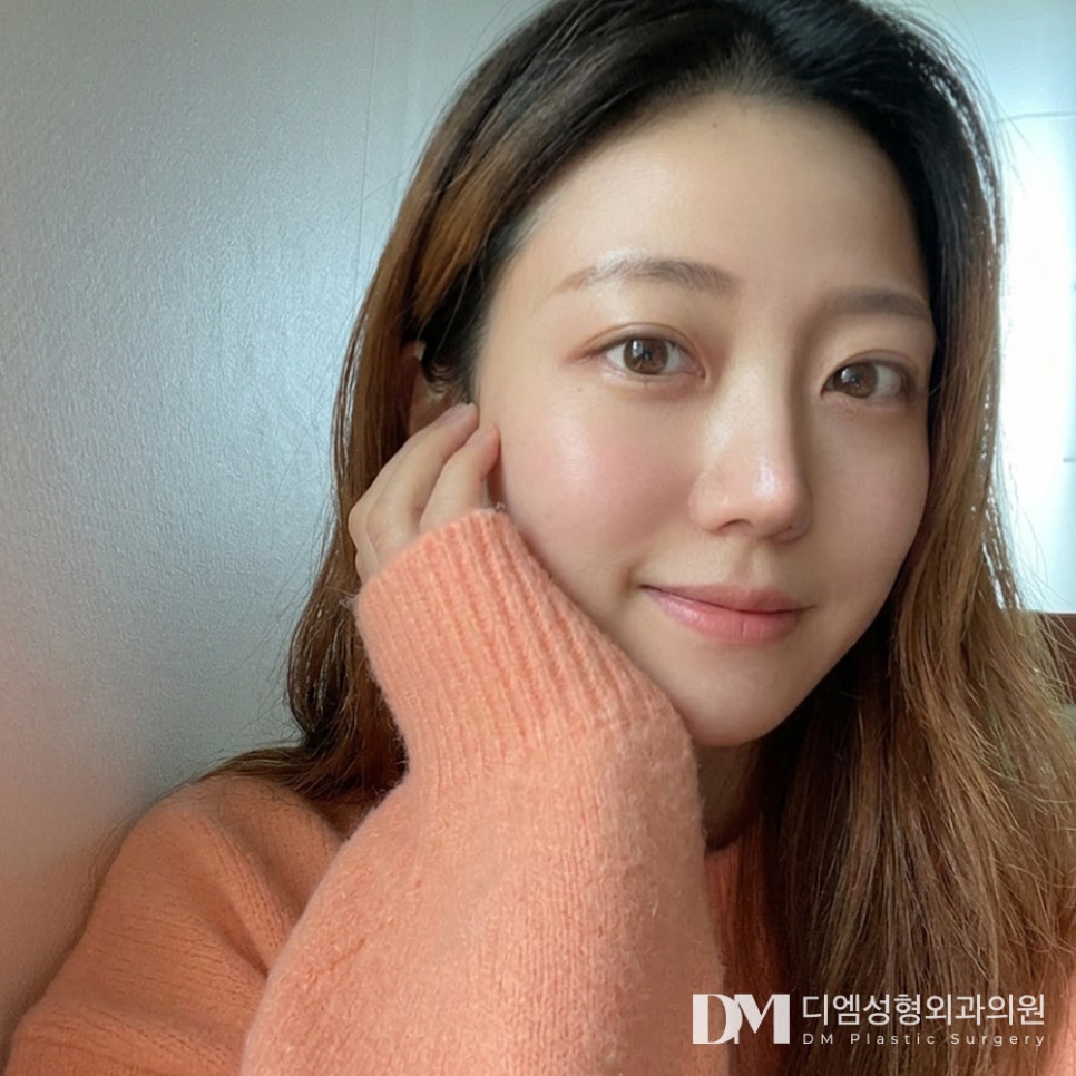 디엠 눈재수술 전후사진, 더 이상 실패하지 않으려면! 관련 이미지 3