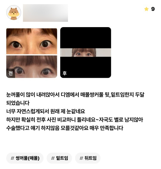 눈성형 후기."너무 자연스럽게 되서 원래 제 눈 같네요 " 관련 이미지 1