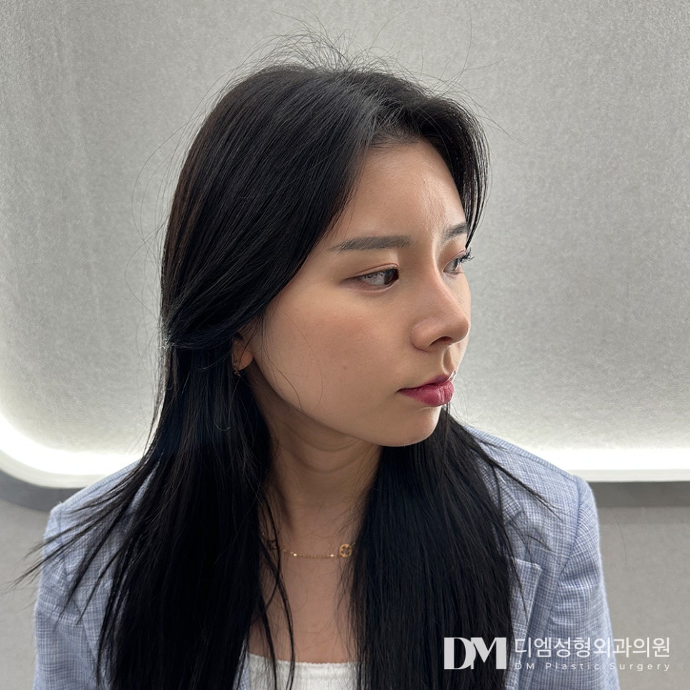 얼굴지방이식 , 볼륨감을 채워 조화로운 얼굴로 관련 이미지 9