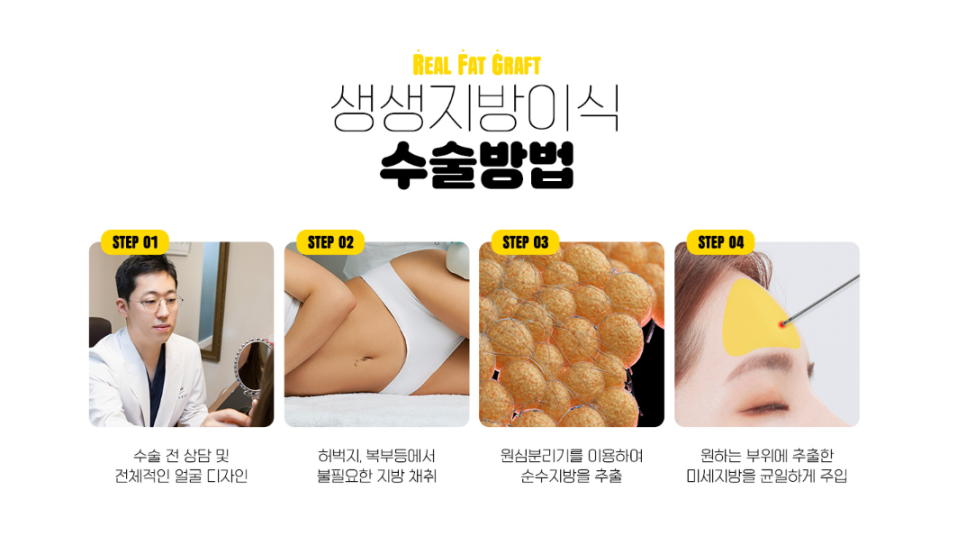 냉동지방이 아닌 생생 지방으로 ! 디엠 얼굴지방이식 관련 이미지 8