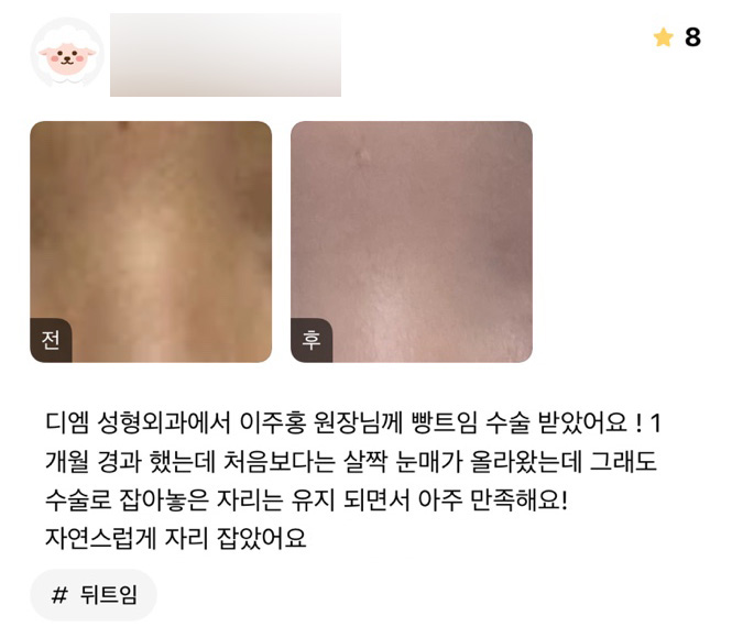 Canthoplasty Review: “I’m Very Satisfied! It Settled Naturally” image 1