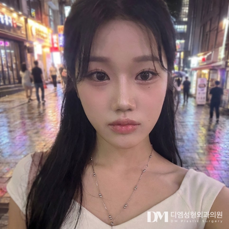 디엠 낮은코성형 전후사진, 입체적인 코 라인의 비결은? 관련 이미지 1