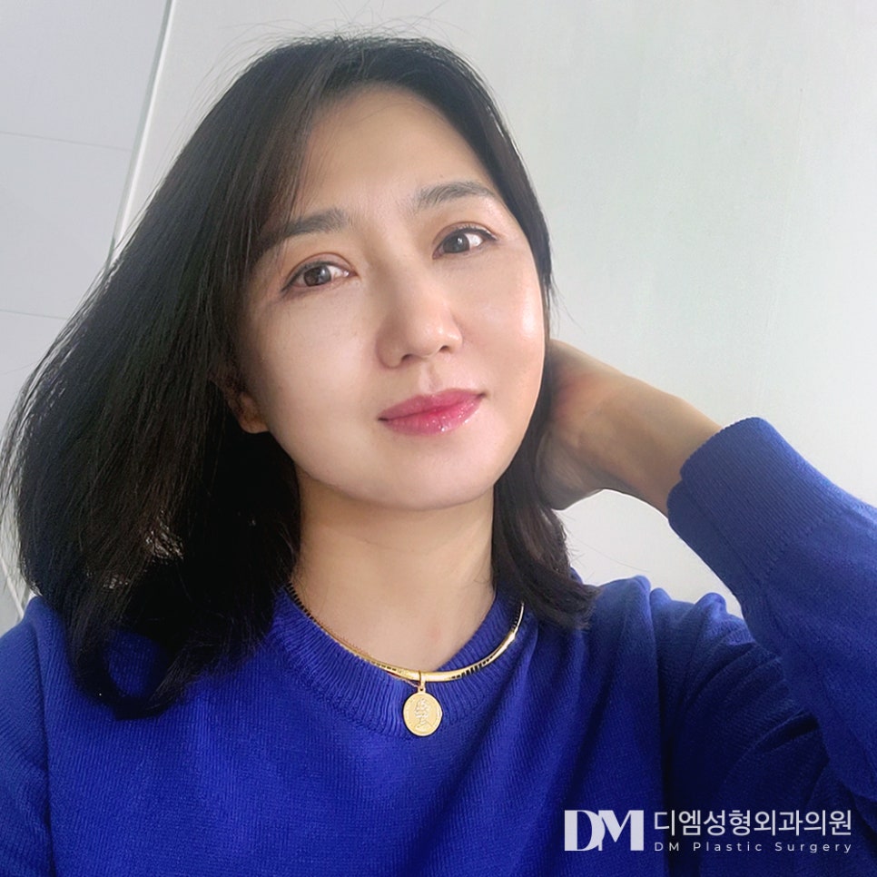 디엠 안면거상 전후사진, 안면거상 시 반드시 체크해야 할 핵심은? 관련 이미지 1