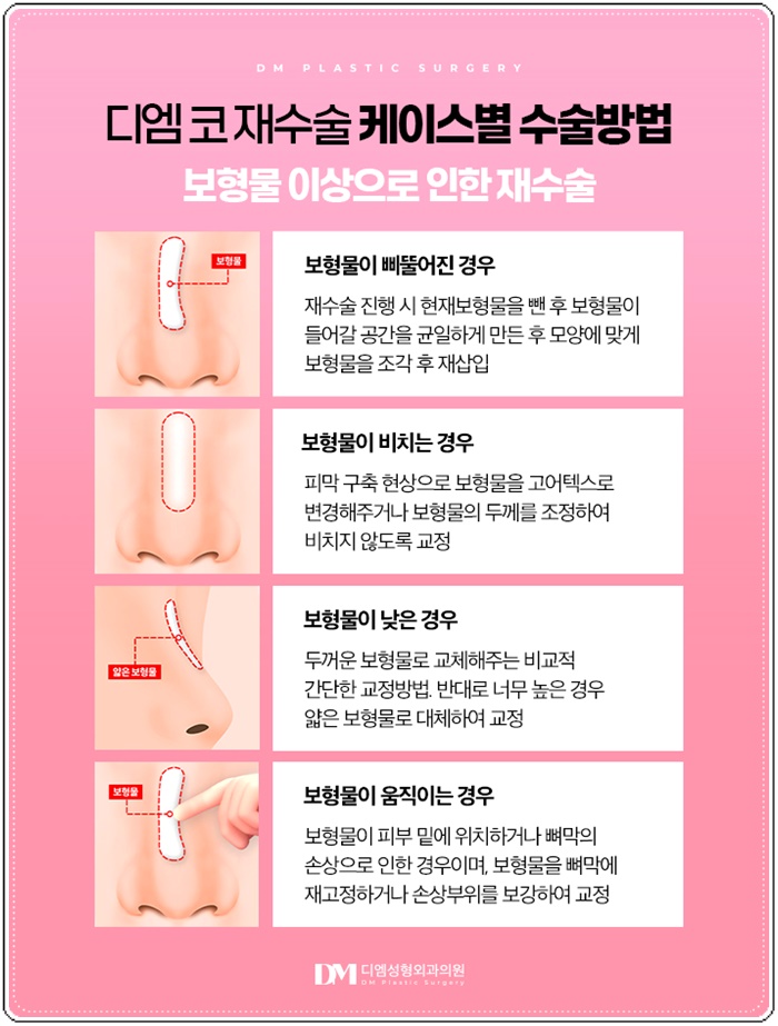 코재수술, 첫코성형 실패 원인 분석이 우선! 관련 이미지 8
