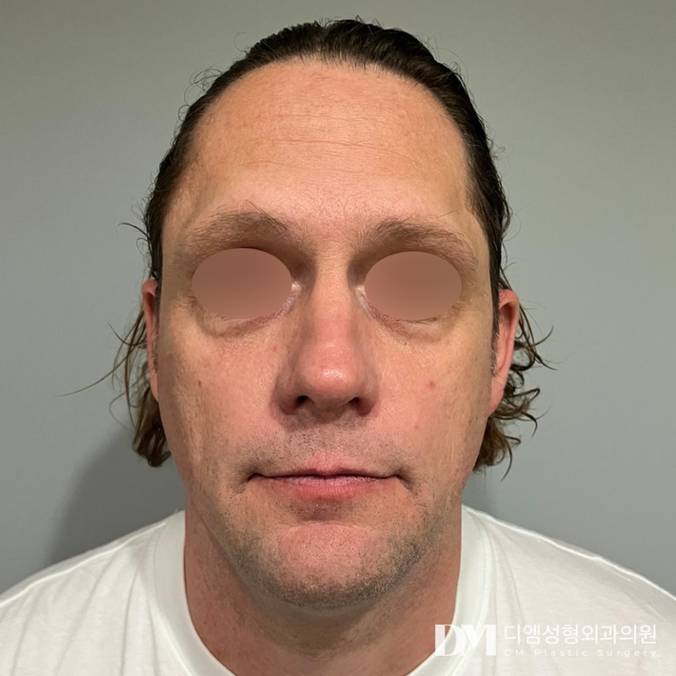 Partial Facelift: Concerned About Drooping Eyes and Wrinkles Around the Eyes? image 7