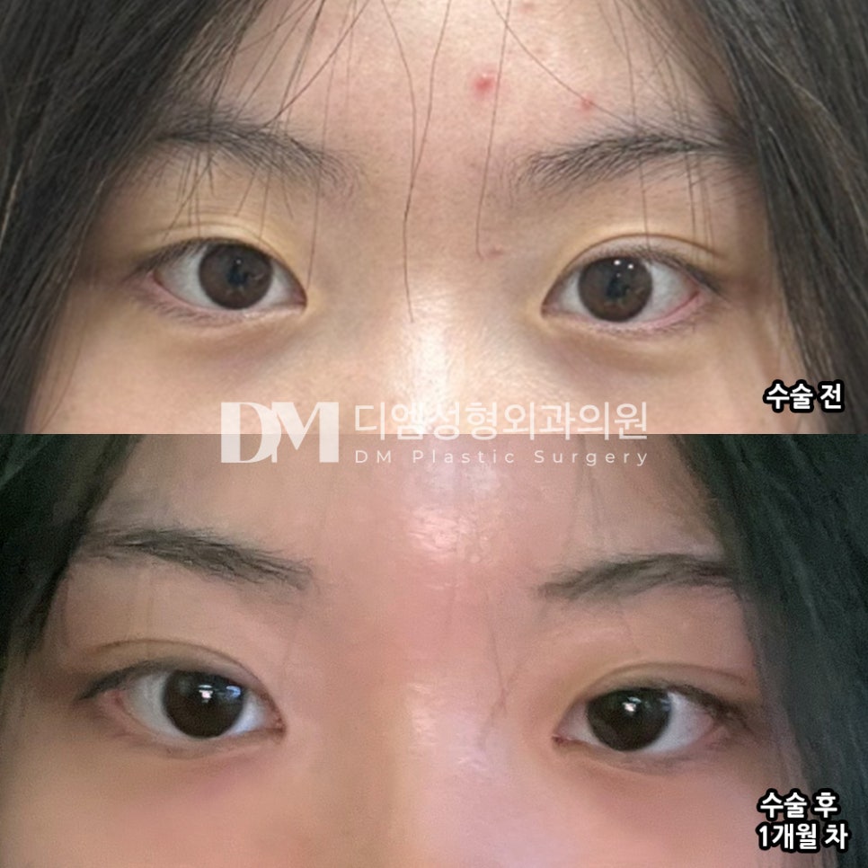 쌍꺼풀 수술, 내 눈에 적합한 방법은? 관련 이미지 10