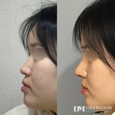 코성형 후기."직원 모두 친절하시고 6개월 후가 기대돼요!" 관련 이미지 3