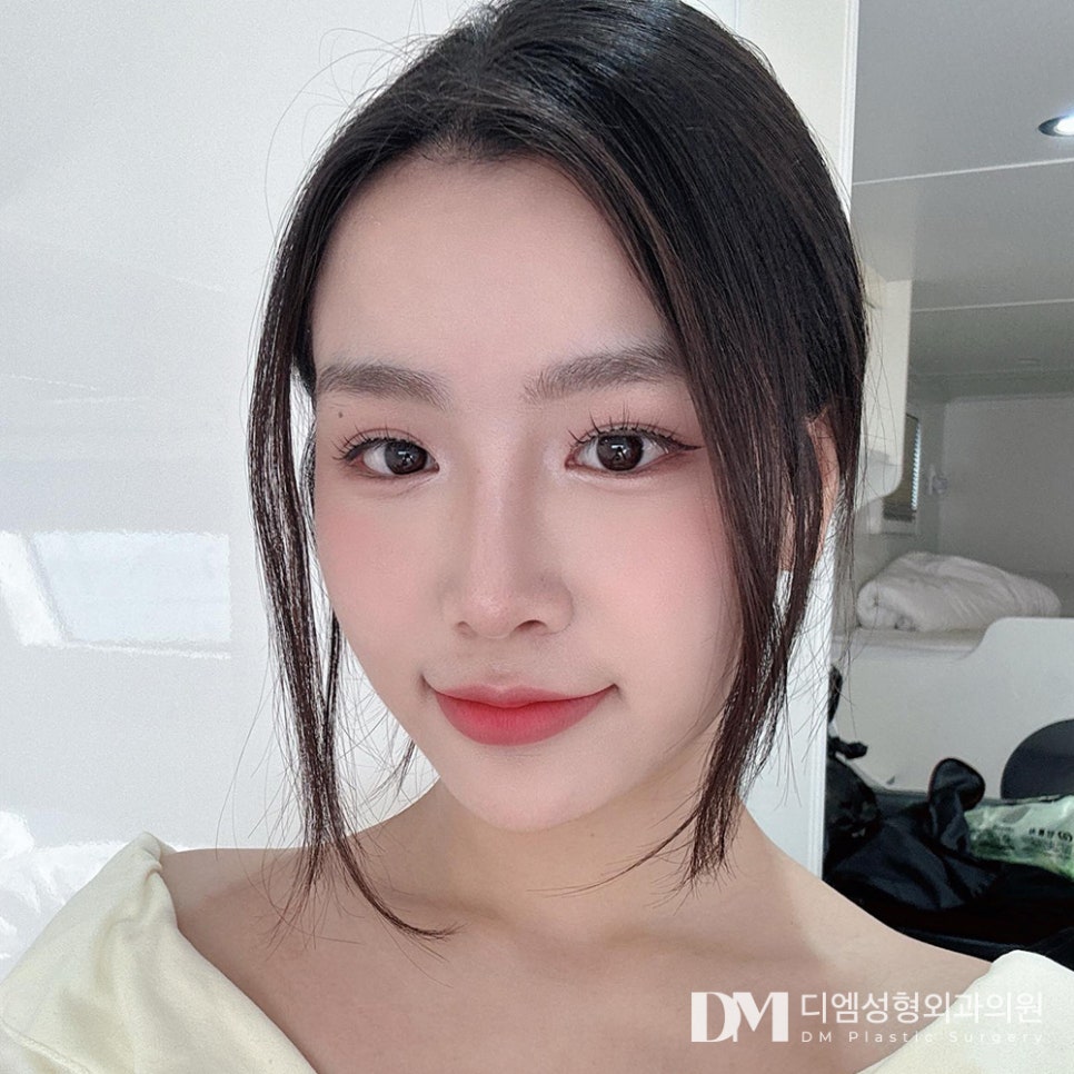 Double-Eyelid Surgery: Looking Your Best for Spring image 1