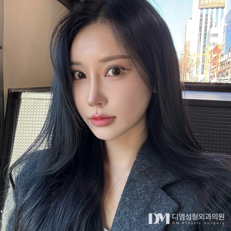 눈재수술, 실패의 흔적을 지우고 새롭게 시작하기 ! 관련 이미지 1