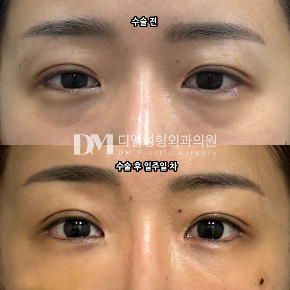 Under-Eye Fat Repositioning Review. "I’m also looking forward to how it settles, and so far I’m really satisfied! 😊" image 2
