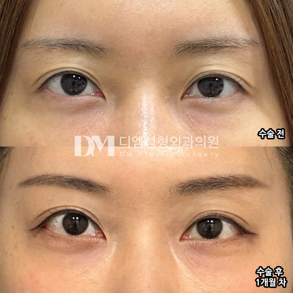 뒤밑트임 후기."전체적으로 만족해요!" 관련 이미지 2