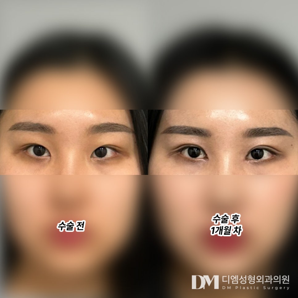 눈재수술, 나에게 맞는 자연스러운 라인으로 관련 이미지 8