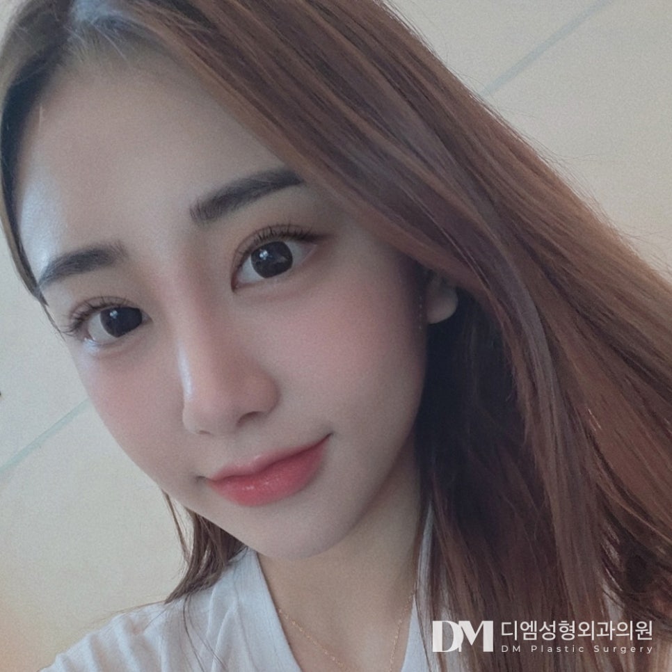 뒤밑트임, 흉터없이 순한 눈매로 관련 이미지 9