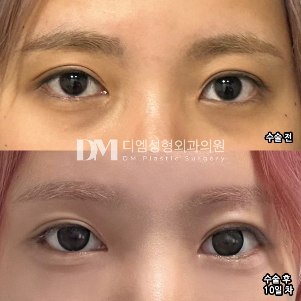 Ppangtteum Review. “It grew naturally to suit my eye shape, which I liked!” image 2