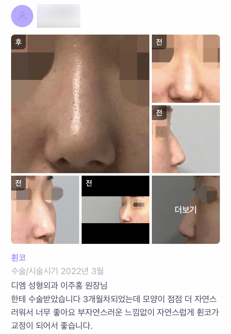 코성형 후기."부자연스러운 느낌없이 자연스럽게 휜 코가 교정이 되어서 좋습니다!" 관련 이미지 1