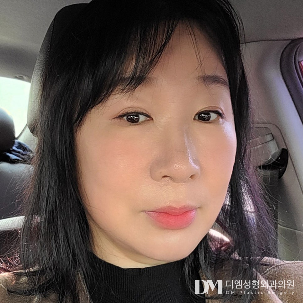 Forehead Lift: Improving Everything from Eyebrow Position to Drooping Eyelids! image 10