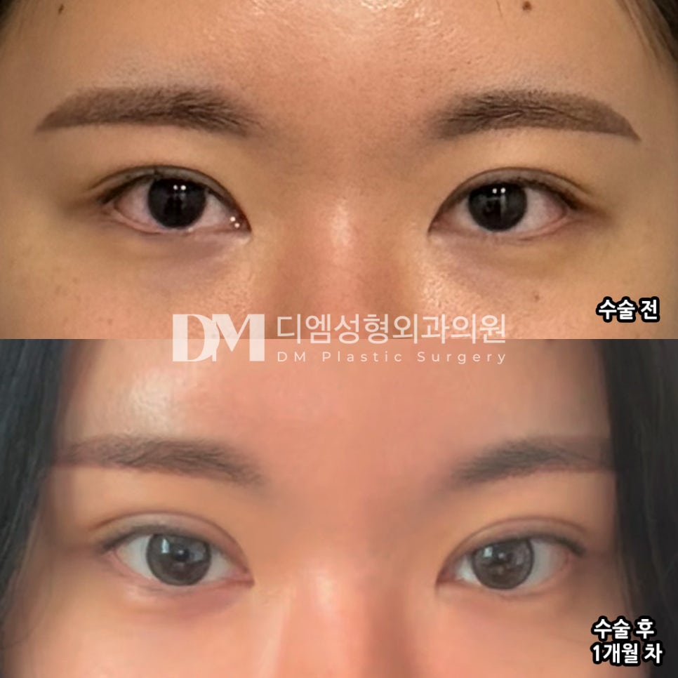 눈재수술 후기."원장님께서 제 니즈를 잘 파악해주셔서 좋았어요!" 관련 이미지 2