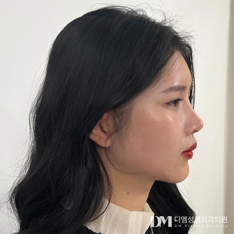 Improving Nasolabial Folds That Make You Look Older with a Partial Facelift image 1