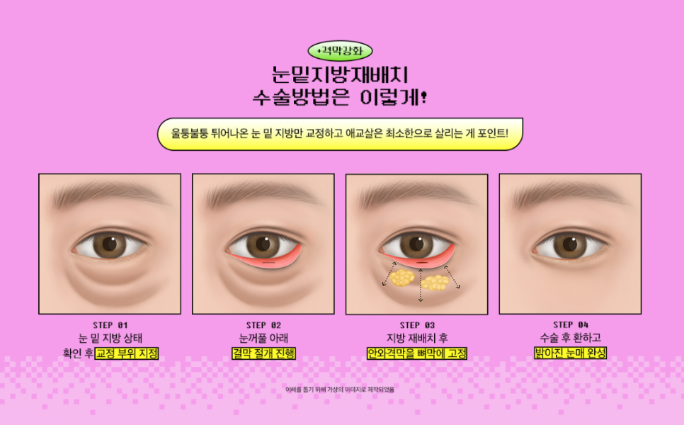 눈밑지방재배치, 노안 이미지와 피곤한 인상이 고민이라면 관련 이미지 4