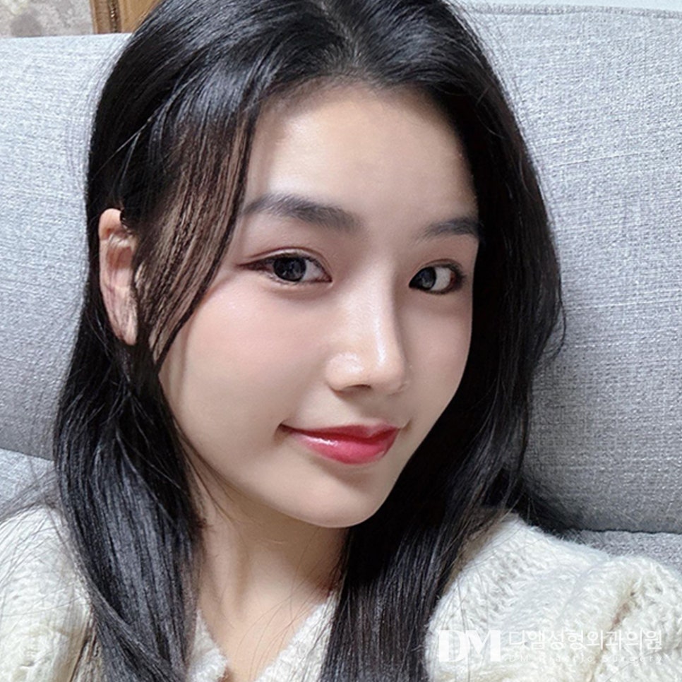 꼬막눈 탈출 가능한 뒤밑트임, 빵트임 회복기간 및 결막부종 총정리! 관련 이미지 1