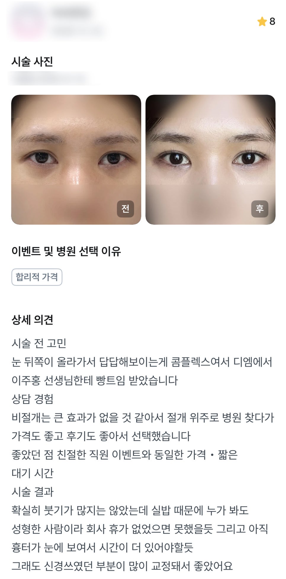 디엠 뒤밑트임/트임성형 후기, &ldquo;신경쓰였던 부분이 많이 교정돼서 좋아요!&rdquo; 관련 이미지 1