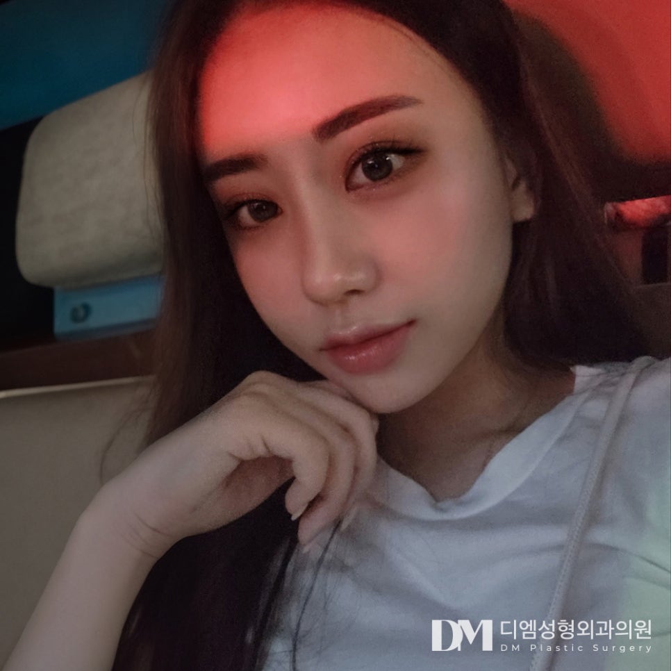짧은코 성형, 얼굴 비율과 인상 동시 개선하기 ! 관련 이미지 11