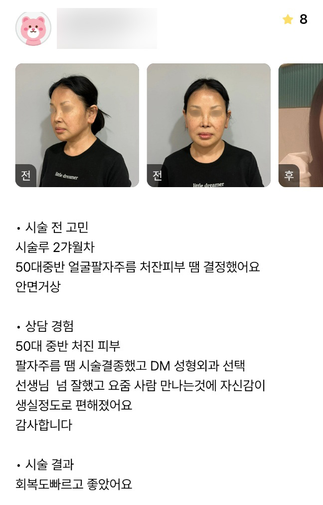 Facelift Review. “I’ve Gained Confidence When Meeting People!” image 1