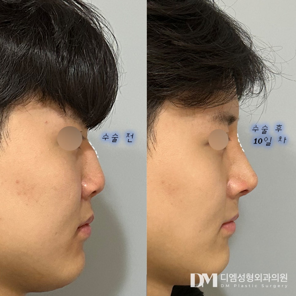 울퉁불퉁해 자신없는 옆모습, 이제 탈출하자 ! 관련 이미지 6