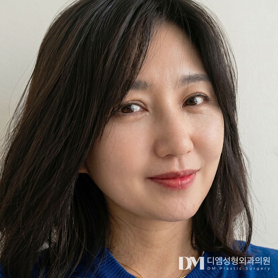 디엠 안면거상 전후사진, 잃어버린 자신감과 탄력 되찾기! 관련 이미지 1