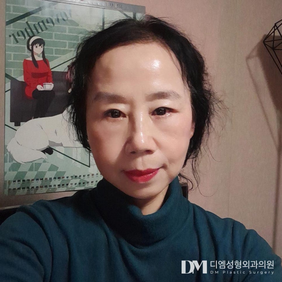 하안검, 눈밑지방이 불룩해 더 나이들어 보인다면? 관련 이미지 1