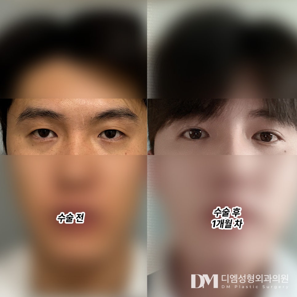 쌍꺼풀수술로 자연스럽게 인상 개선하기 관련 이미지 10