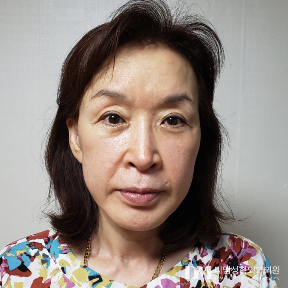 상안검, 눈꺼풀의 노화 해결하기 관련 이미지 13