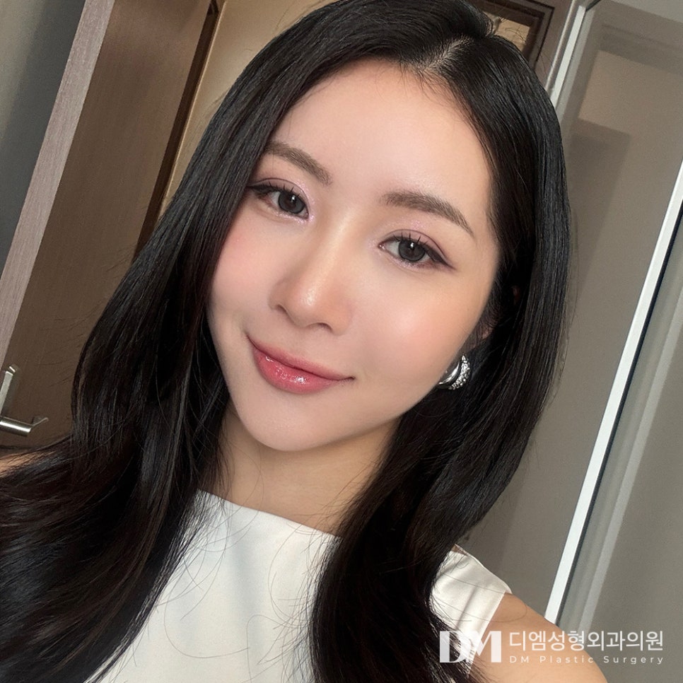 쌍꺼풀이 한쪽만 풀려 비대칭 눈매가 되었다면? 관련 이미지 14