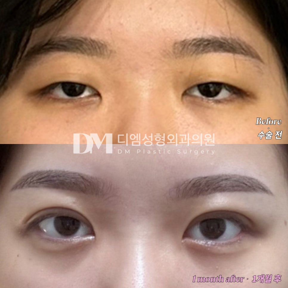 Ptosis Correction: Turning Tired-Looking Eyes into Clear, Bright Eyes image 12