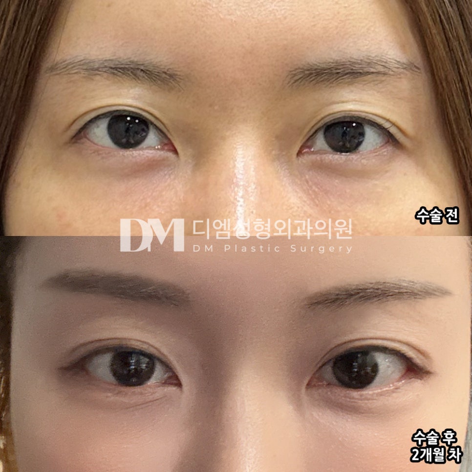 뒤밑트임 후기."과하지 않게 눈이 커져서 좋아요!" 관련 이미지 2