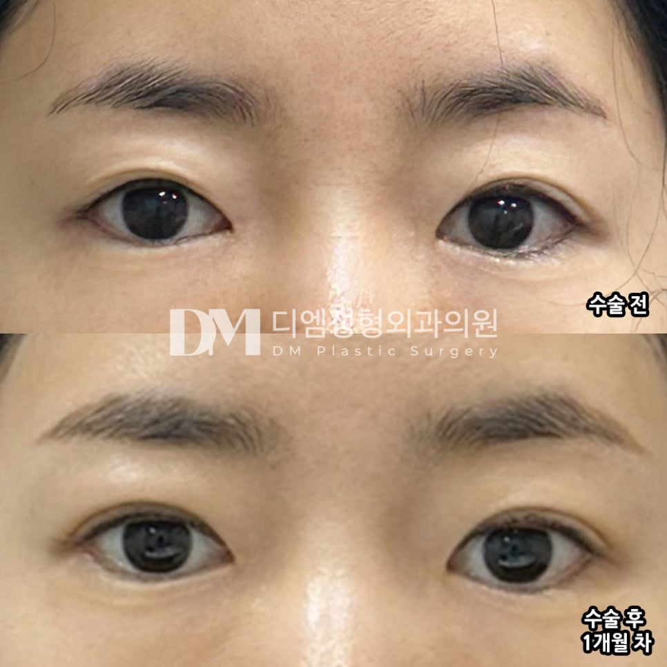 Revision Eyelid Surgery Review. "I like the line, and I hope it stays for a long time!" image 2