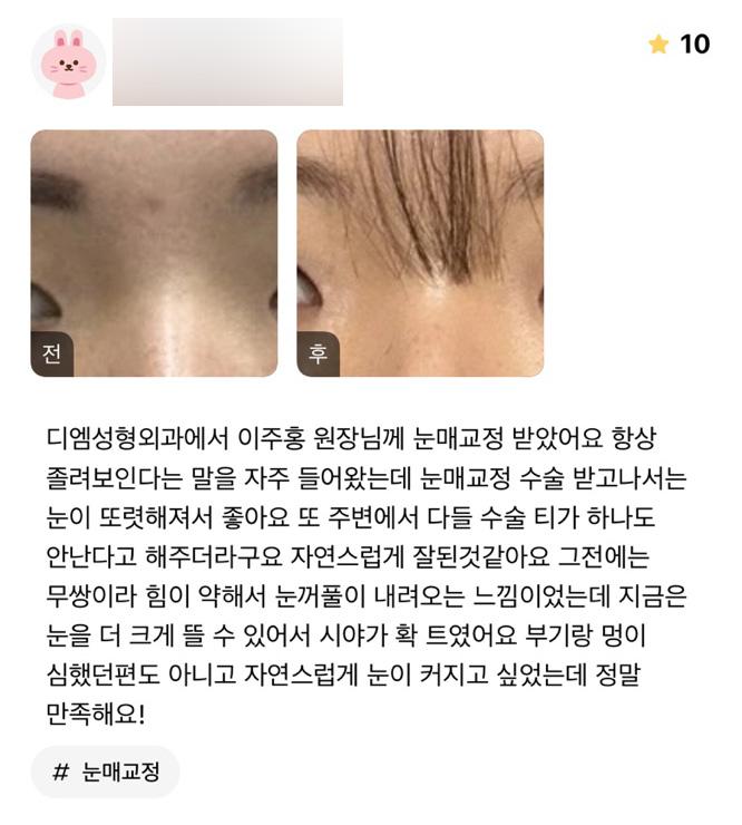 눈성형 후기."자연스럽게 눈이 커져서 만족해요!" 관련 이미지 1