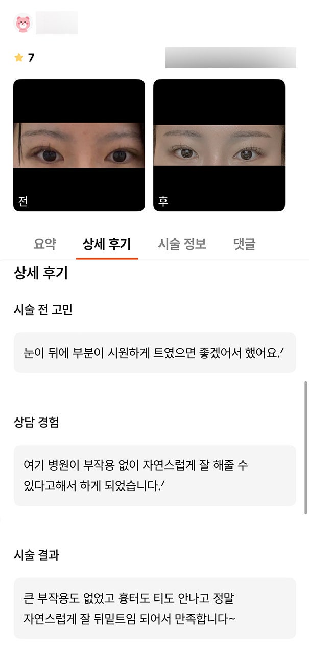 Ppang Eye Corner Surgery Review. "I'm satisfied because it turned out naturally and well!" image 1