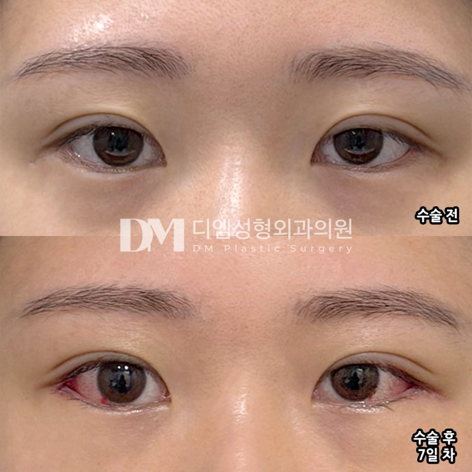 DM Lateral and Lower Canthoplasty Revision Review, “It feels like my eyes have been naturally widened!” image 2