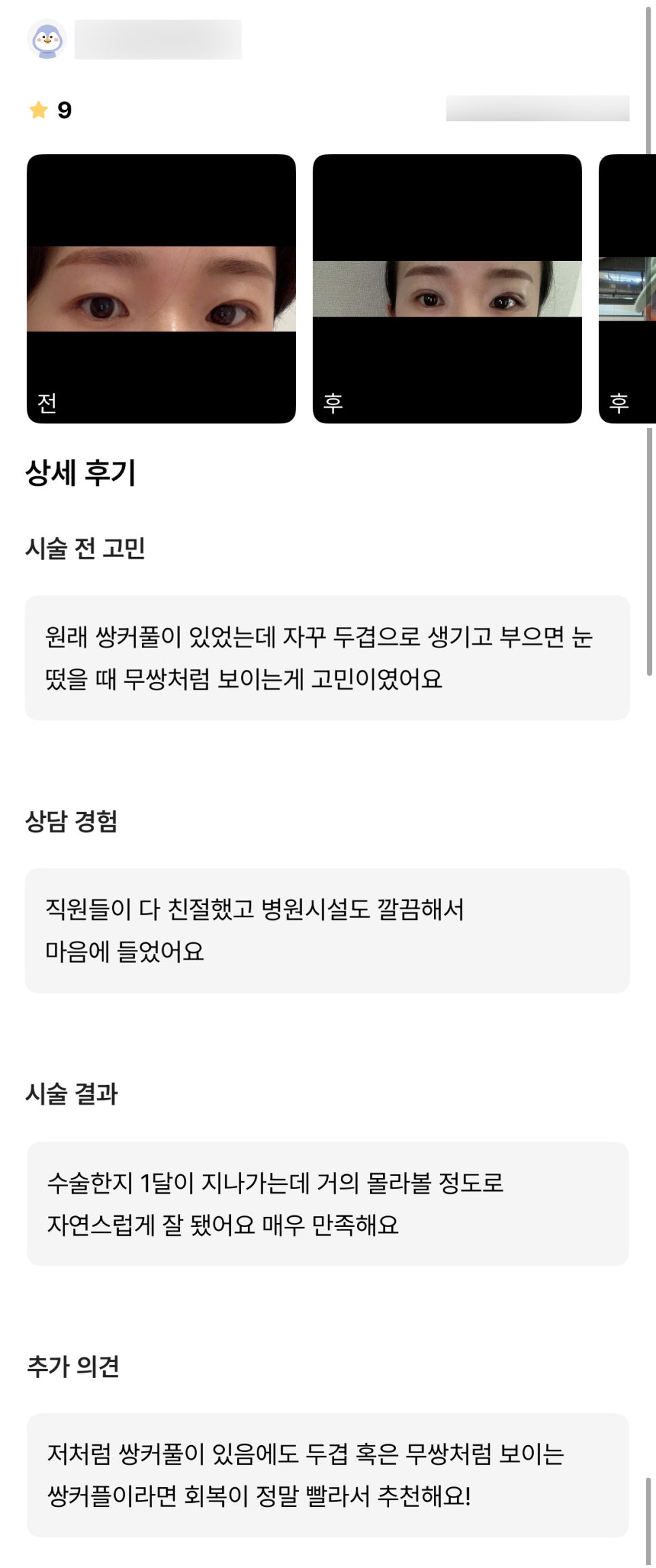 눈성형 후기."거의 몰라볼 정도로 자연스럽게 잘 되어 매우 만족해요!" 관련 이미지 1
