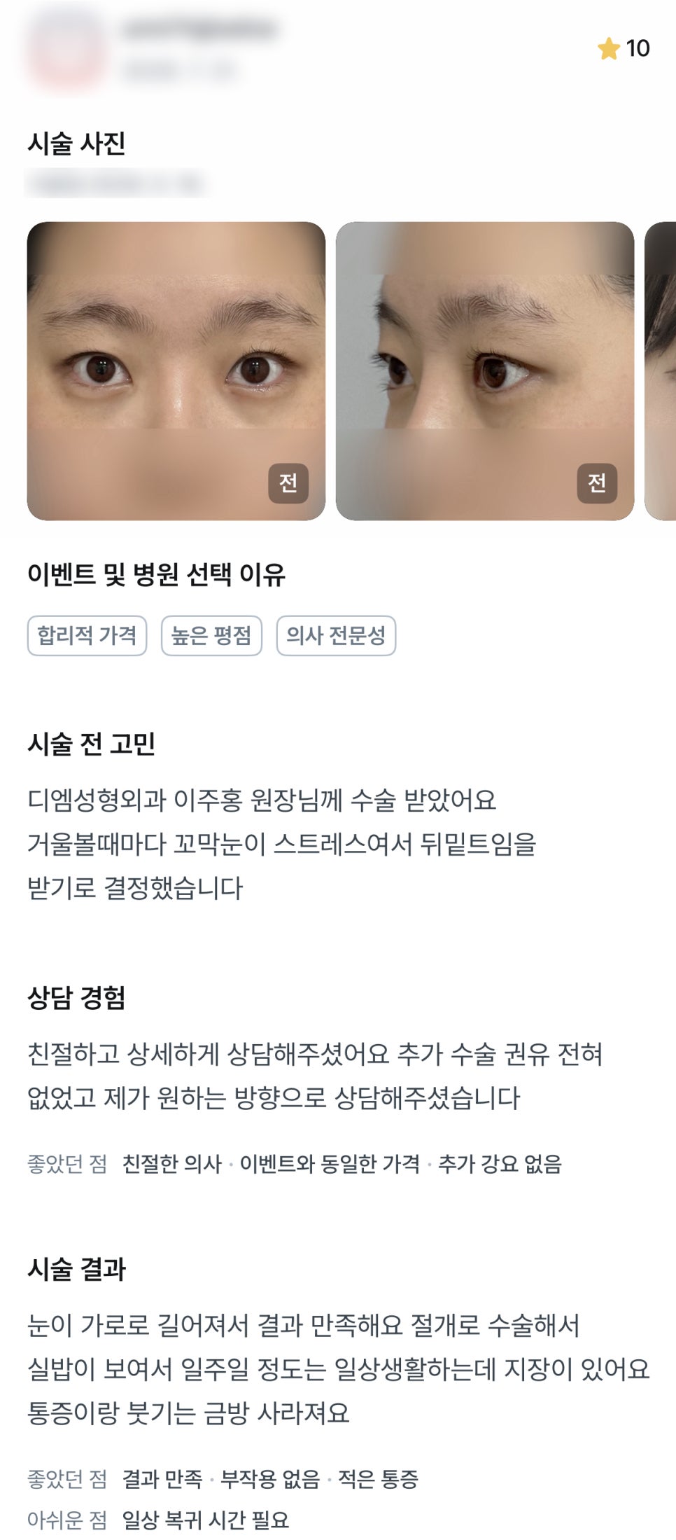DM Lateral and Lower Canthoplasty Surgery Review, “I’m Satisfied with the Results Because My Eyes Look Wider Horizontally!” image 1