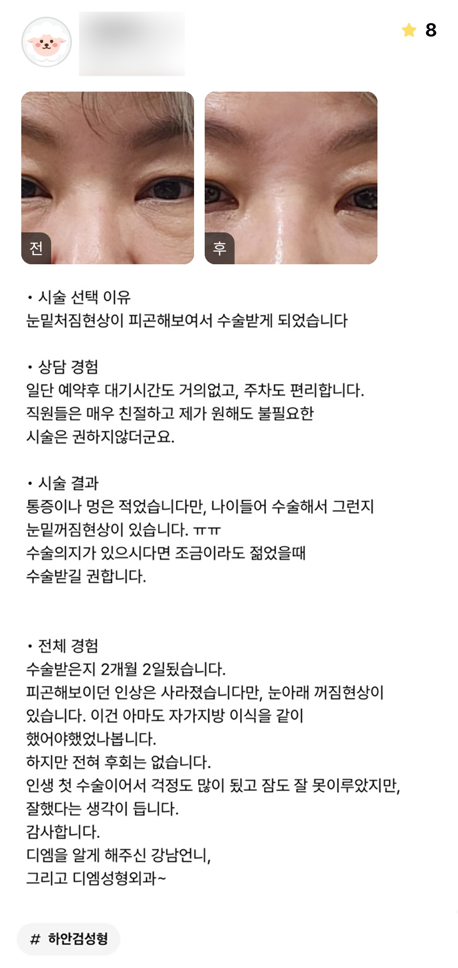 하안검 후기."인생 첫 수술이라 걱정이 많았지만 잘했다는 생각이 들어요!" 관련 이미지 1