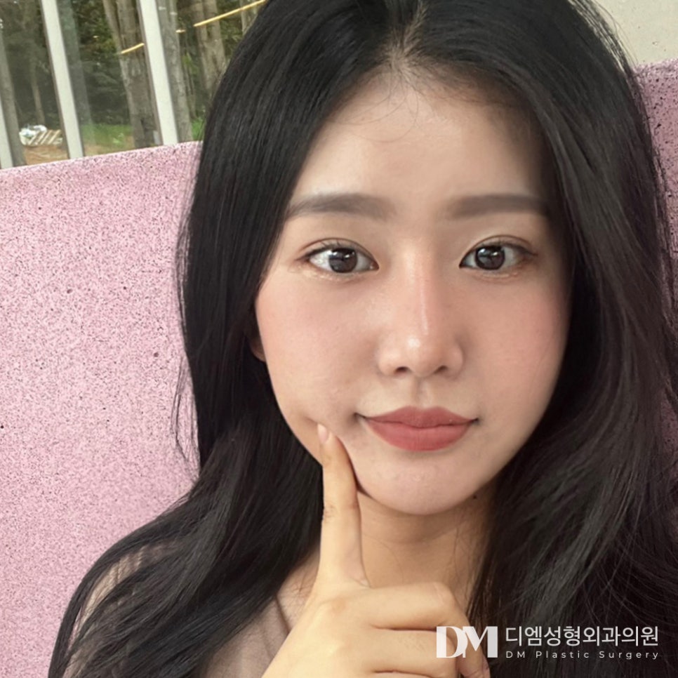 눈밑지방재배치로 다크서클과 노안 개선이 가능할까?? 관련 이미지 1