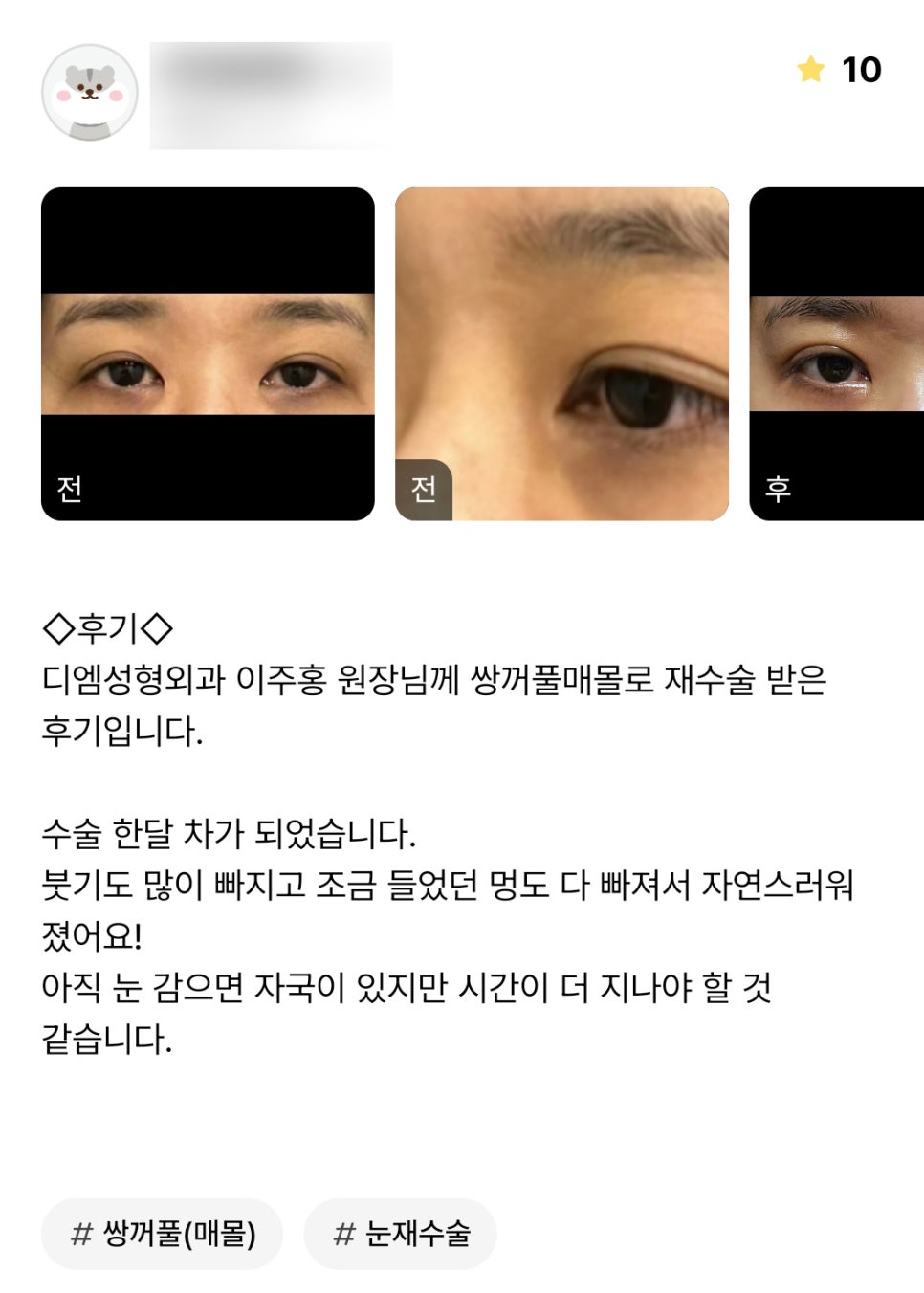 Revision Eyelid Surgery Review: “I’m Satisfied That It Looks Much More Natural!” image 1