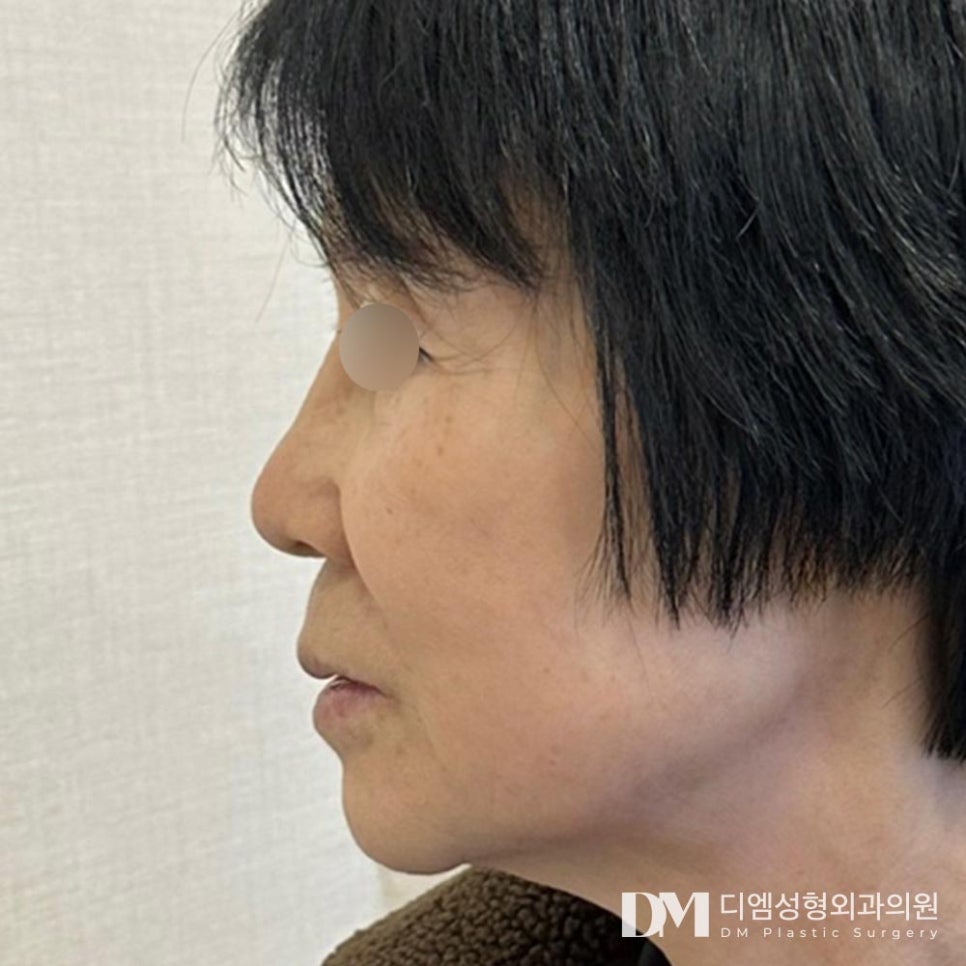 안면거상, 개인별 맞춤형 플랜으로 더욱 높아진 만족도! 관련 이미지 6