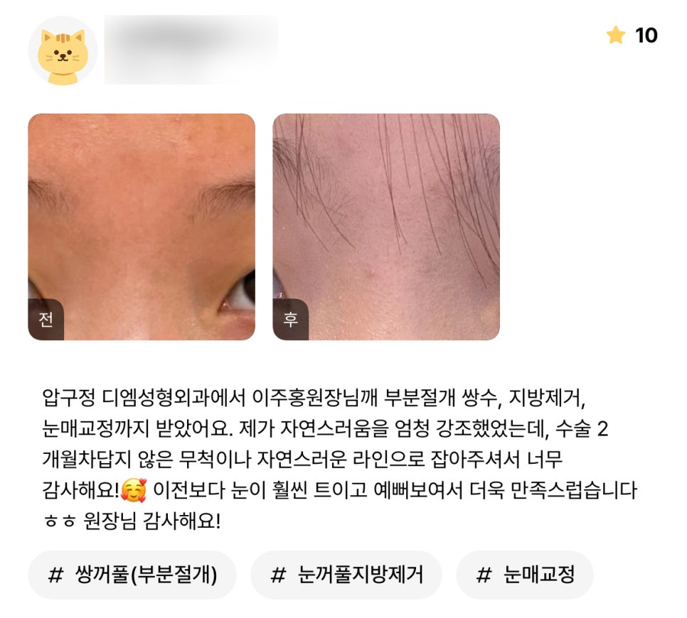 눈성형 후기."이전보다 눈이 훨씬 트이고 예뻐보여서 더 만족스러워요!" 관련 이미지 1