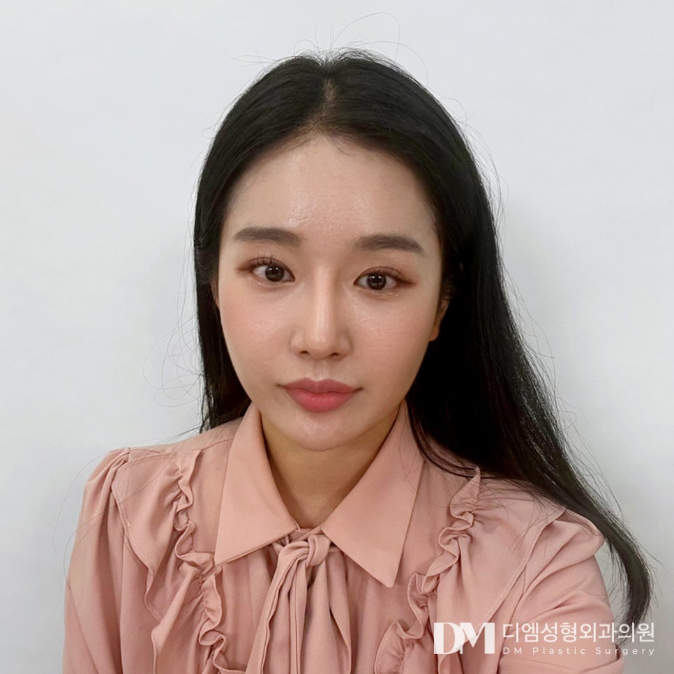 피곤하고 졸려보이는 눈 , 눈매교정으로 개선 가능할까? 관련 이미지 1
