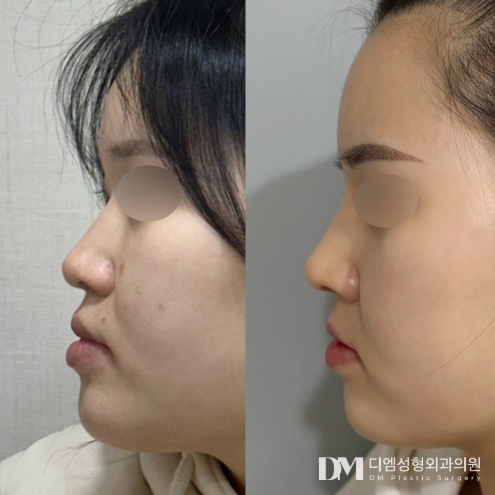 Rhinoplasty Review: “Now that the swelling has gone down, the shape looks even prettier, so I’m very satisfied!” image 2
