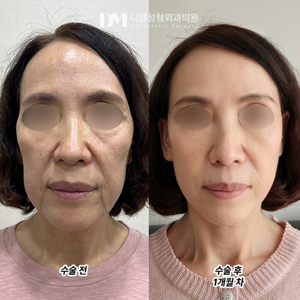 디엠 안면거상 전후사진, 안면거상 시 반드시 체크해야 할 핵심은? 관련 이미지 2